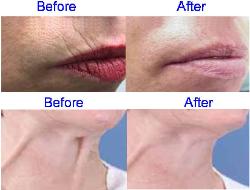 Botox Before & After for the Upper Lip